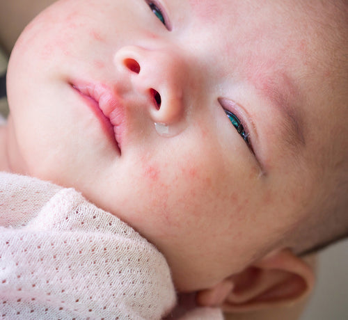 Bebé con un brote de dermatitis atópica en la cara - solucionesbanohub.compaña - 1