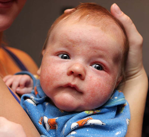 Bebé con eccema en la cara por la dermatitis atópica. - solucionesbanohub.compaña - 1