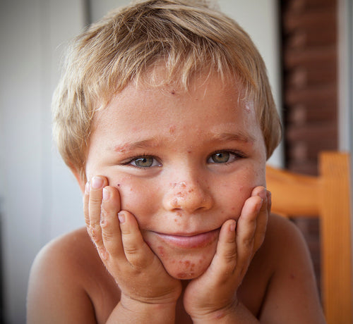 Un niño de menos de un año con un brote de eccema en la cara - solucionesbanohub.compaña - 1
