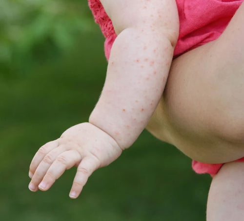 Brote de dermatitis atópica en el brazo de un bebé. - solucionesbanohub.compaña - 1