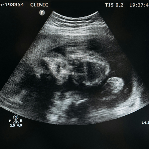 ecografía bebe para saber su sexo - solucionesbanohub.compaña - 1
